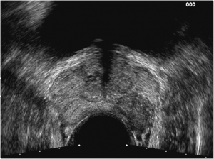 iperplasiaprostaticandrologiapuglia003