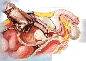 iperplasiaprostaticandrologiapuglia006