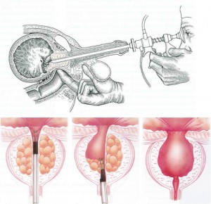 iperplasiaprostaticandrologiapuglia010